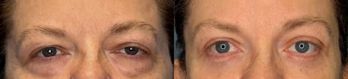 Before & After Eyelid Surgery Case 423 Front View in Ann Arbor, MI