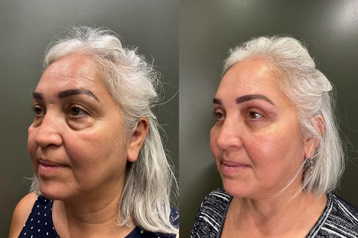 Before & After Eyelid Surgery Case 429 Left Side View in Ann Arbor, MI