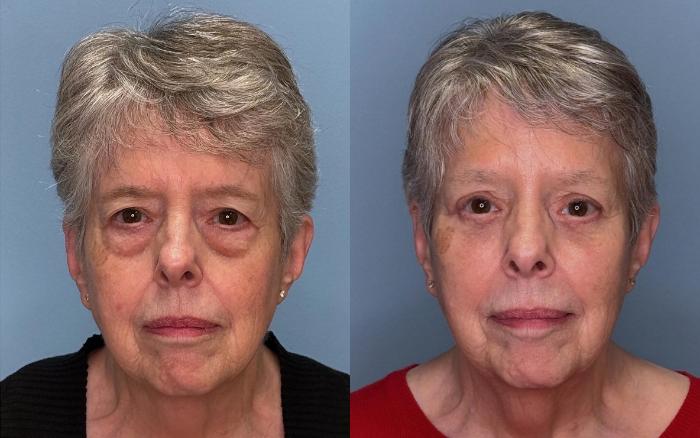 Before & After Eyelid Surgery Case 430 Front View in Ann Arbor, MI