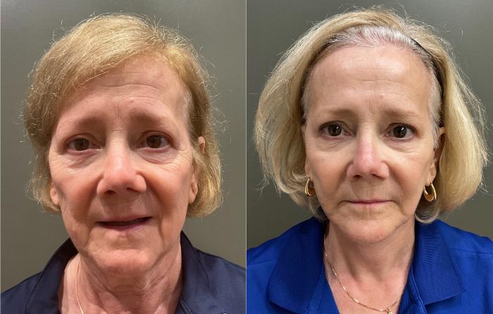 Before & After Facelift Case 420 Front View in Ann Arbor, MI
