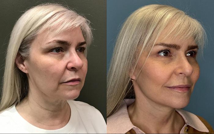 Before & After Facelift Case 444 Right Oblique View in Ann Arbor, MI