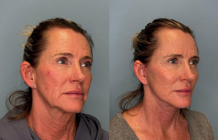 Before & After Facelift Case 445 Right Side View in Ann Arbor, MI