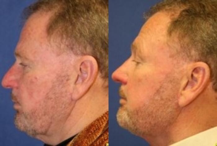 Before & After Rhinoplasty Case 157 Left Side View in Ypsilanti, MI