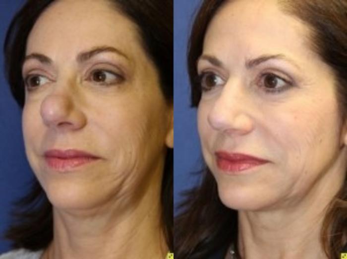 Before & After Rhinoplasty Case 160 Left Oblique View in Ypsilanti, MI