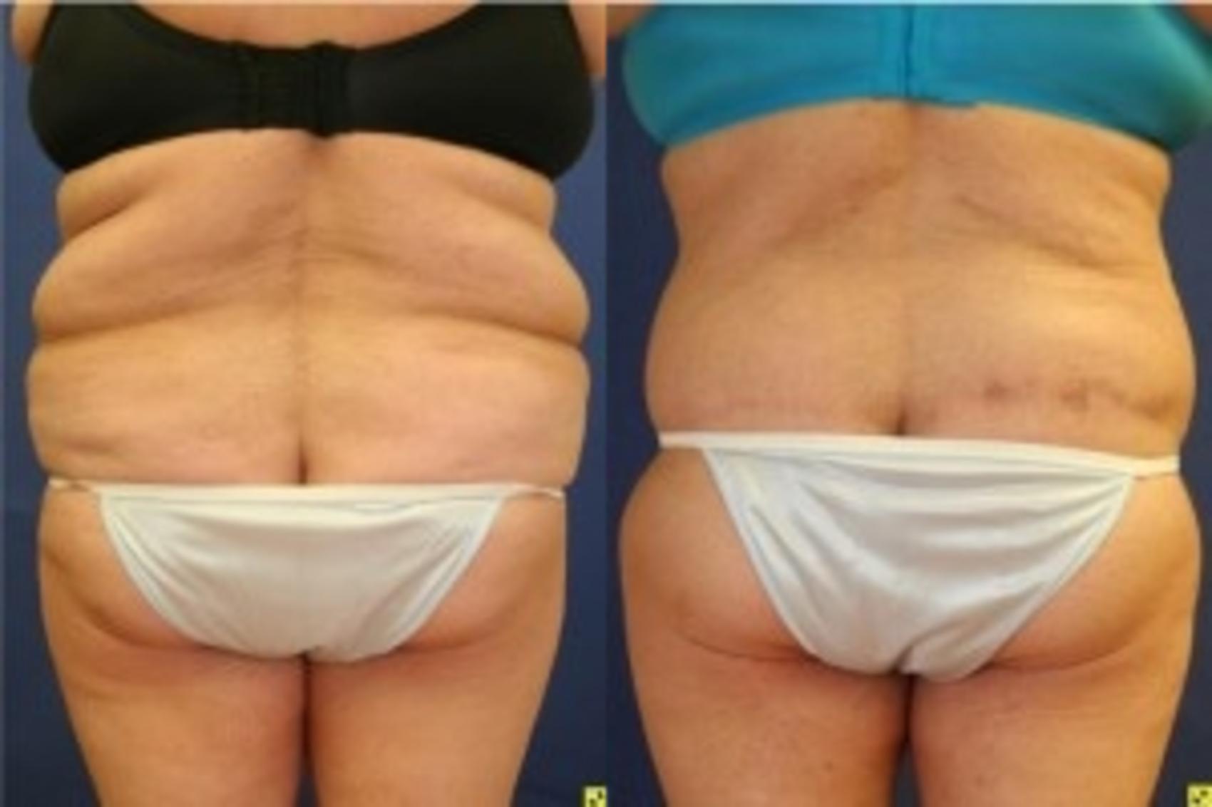 Before & After Body Contouring After Weight Loss Case 246 Back View in Ann Arbor, MI
