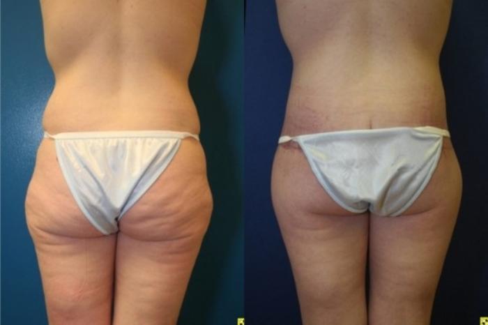 Before & After Body Contouring After Weight Loss Case 267 Back View in Ann Arbor, MI