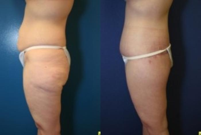 Before & After Body Contouring After Weight Loss Case 267 Left Side View in Ann Arbor, MI