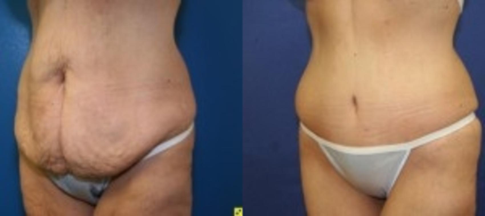Before & After Tummy Tuck Case 3 Front View in Ann Arbor, MI