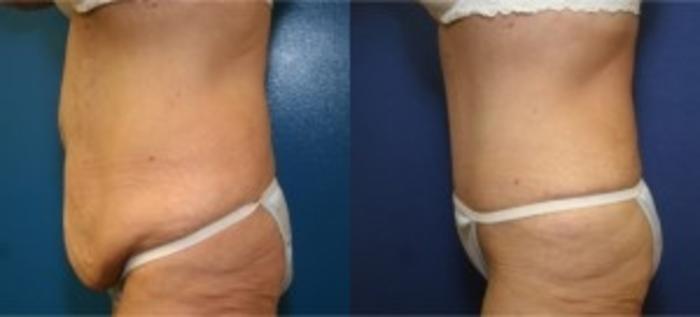 Before & After Tummy Tuck Case 3 Left Side View in Ann Arbor, MI