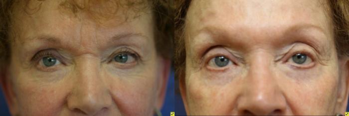 Before & After BOTOX® Cosmetic & Dysport® Case 328 Front View in Ypsilanti, MI