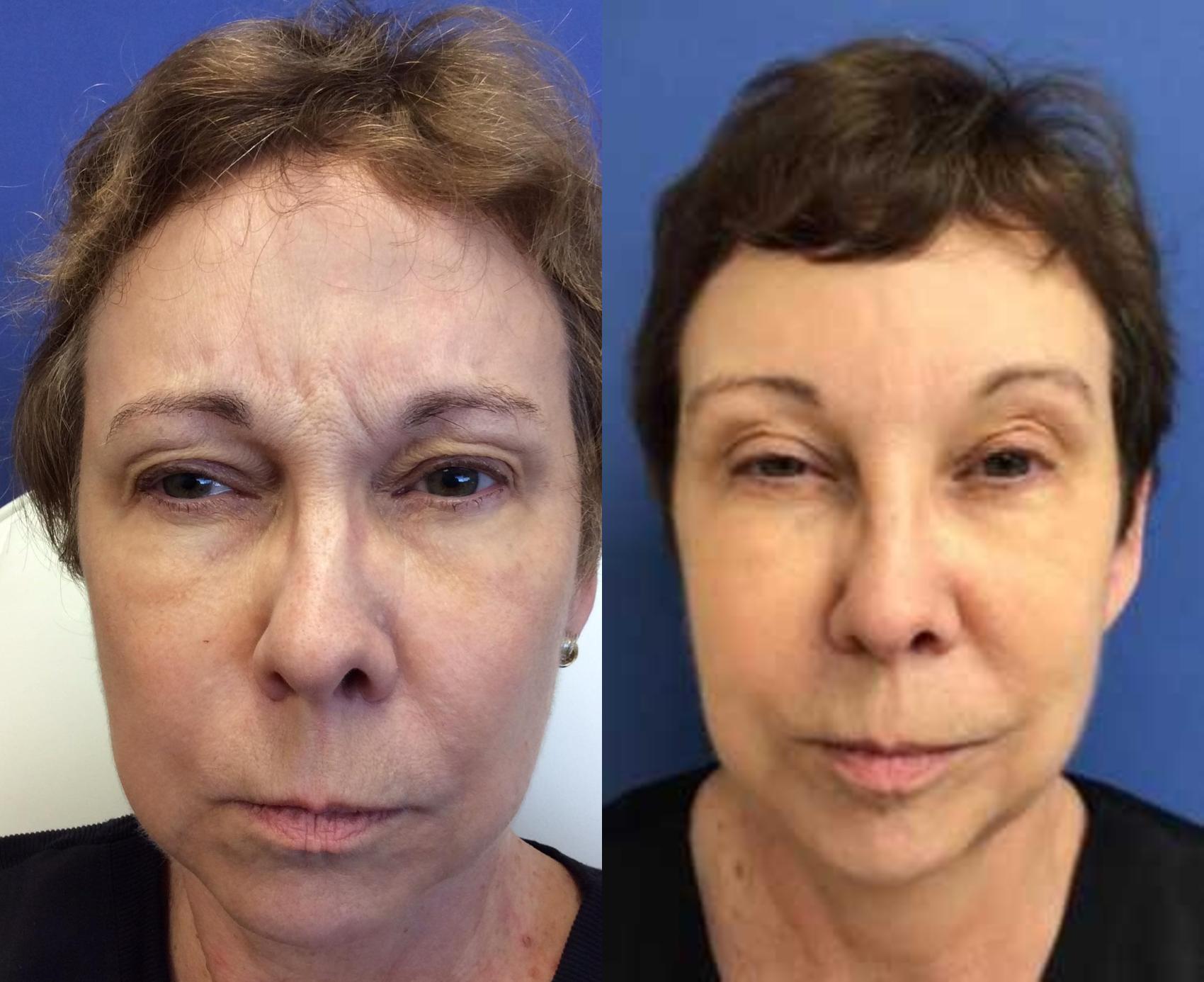 Before & After BOTOX® Cosmetic & Dysport® Case 329 Front View in Ypsilanti, MI