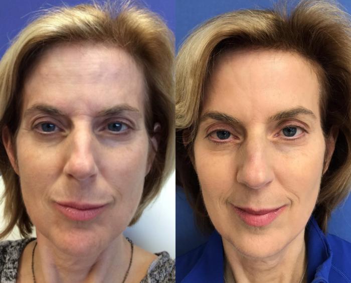 Before & After BOTOX® Cosmetic & Dysport® Case 330 Front View in Ypsilanti, MI