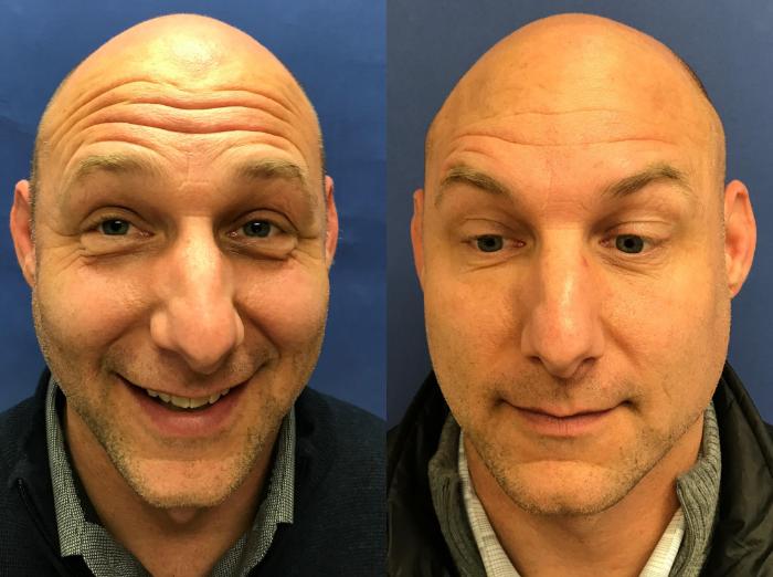Before & After BOTOX® Cosmetic & Dysport® Case 333 Front View in Ypsilanti, MI