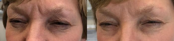 Before & After BOTOX® Cosmetic & Dysport® Case 336 Front View in Ypsilanti, MI