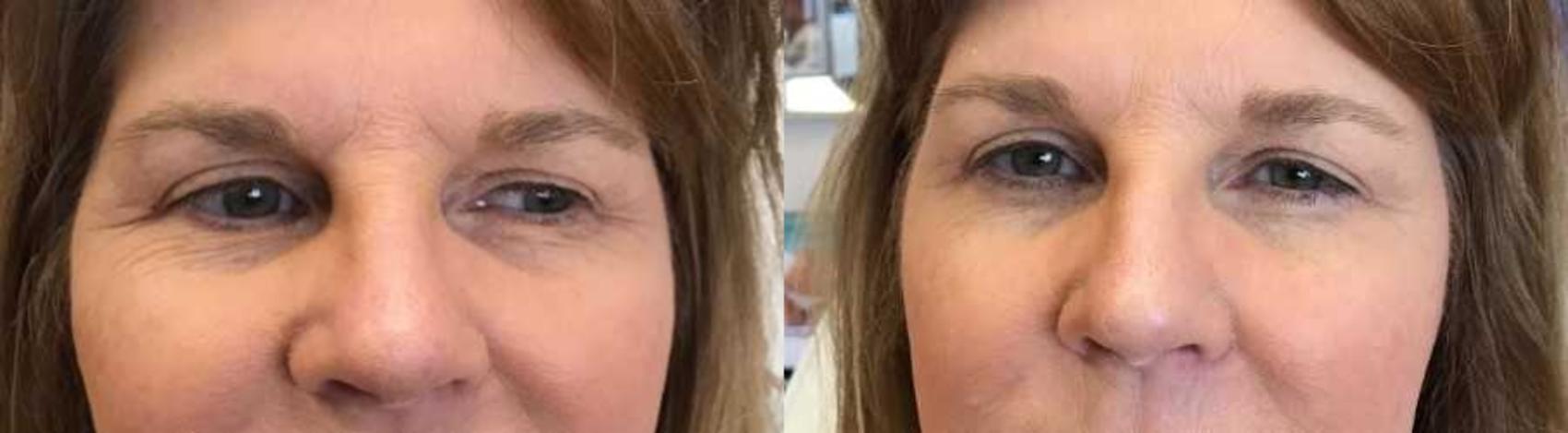 Before & After BOTOX® Cosmetic & Dysport® Case 338 Front View in Ypsilanti, MI