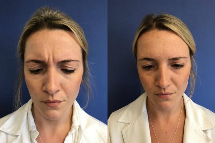 Before & After BOTOX® Cosmetic & Dysport® Case 339 Front View in Ann Arbor, MI