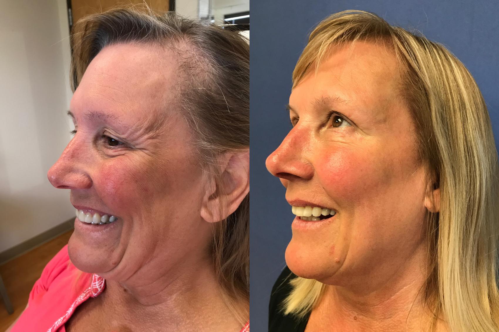 Before & After BOTOX® Cosmetic & Dysport® Case 341 Left Side View in Ypsilanti, MI