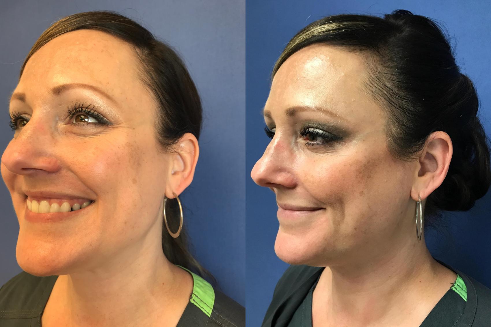 Before & After BOTOX® Cosmetic & Dysport® Case 342 Crow's Feet View in Ann Arbor, MI