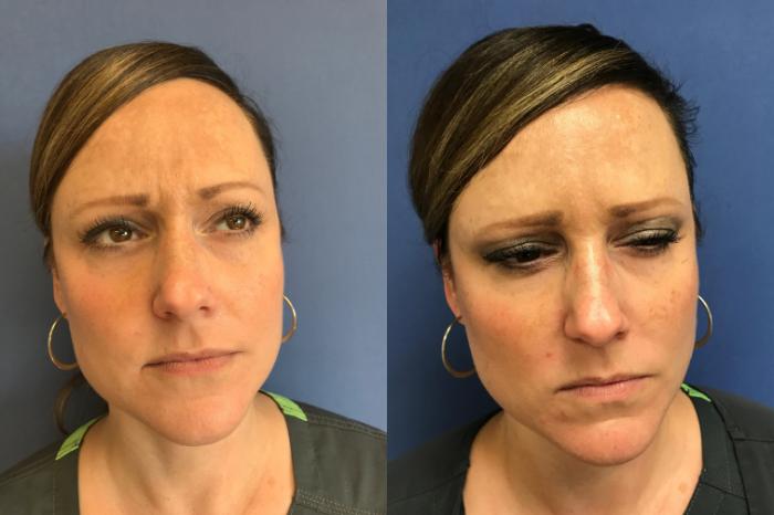 Before & After BOTOX® Cosmetic & Dysport® Case 342 Glabella View in Ann Arbor, MI