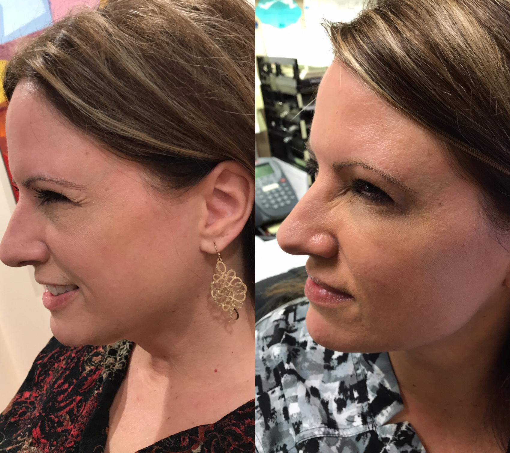 Before & After BOTOX® Cosmetic & Dysport® Case 343 Left Side View in Ann Arbor, MI