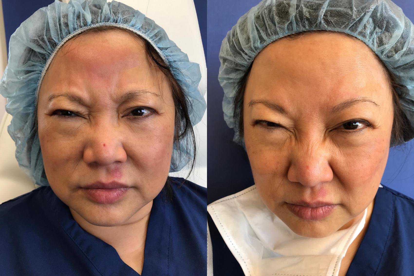 Before & After BOTOX® Cosmetic & Dysport® Case 344 Front View in Ann Arbor, MI