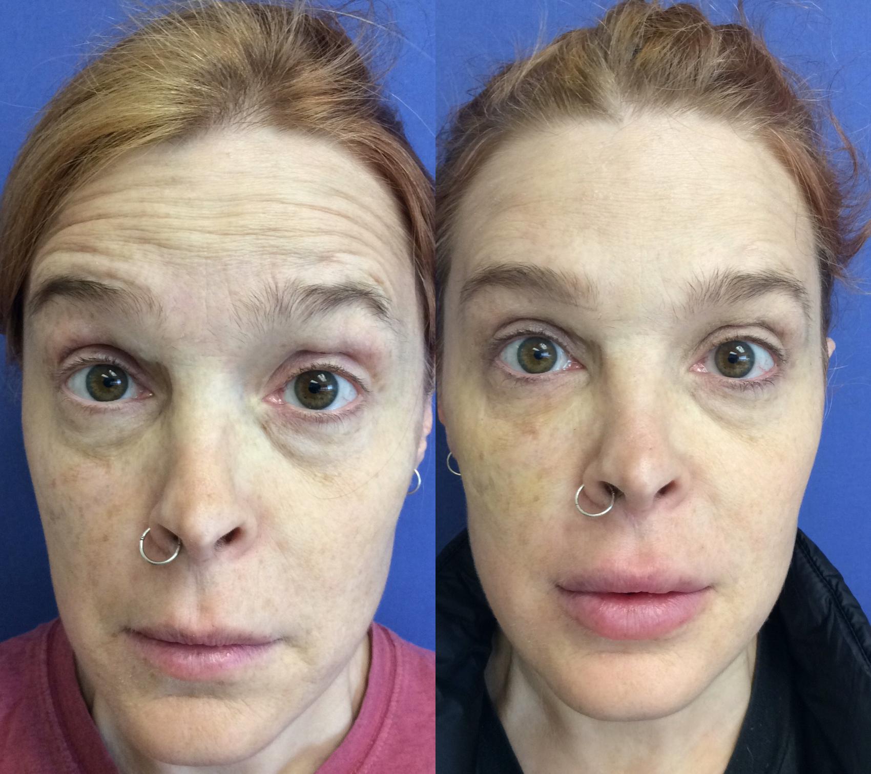 Before & After BOTOX® Cosmetic & Dysport® Case 345 Front View in Ypsilanti, MI