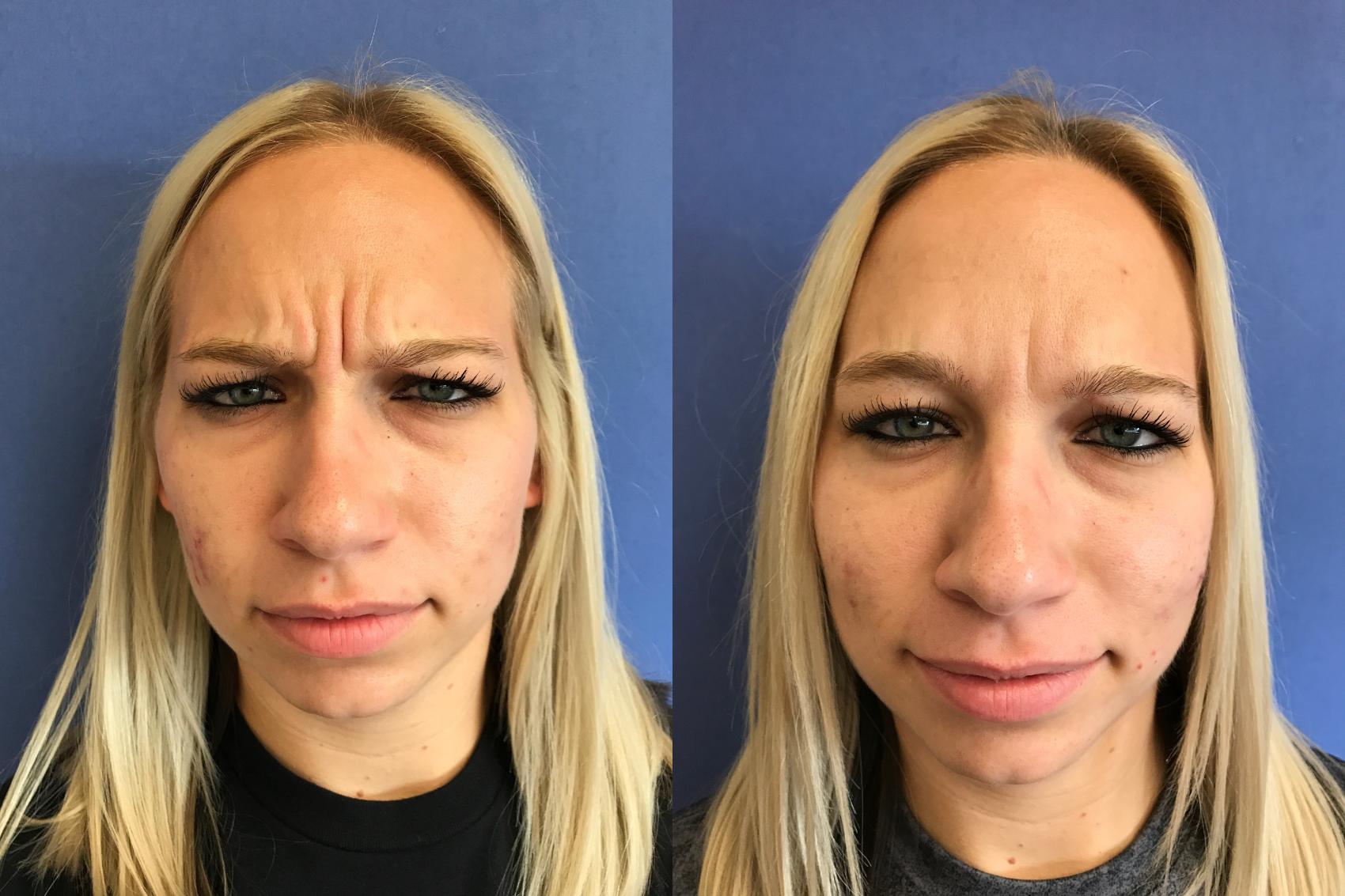 Before & After BOTOX® Cosmetic & Dysport® Case 346 Front View in Ypsilanti, MI