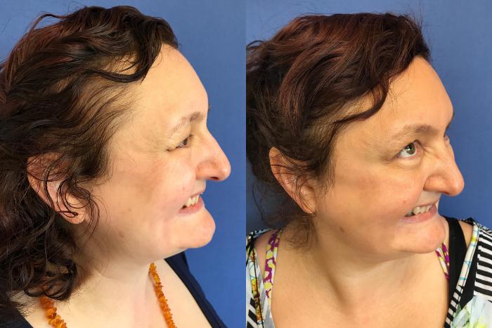 Before & After BOTOX® Cosmetic & Dysport® Case 347 Crow's Feet View in Ypsilanti, MI