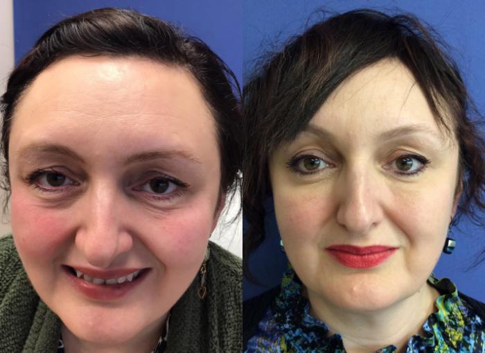 Before & After BOTOX® Cosmetic & Dysport® Case 347 Forehead View in Ypsilanti, MI