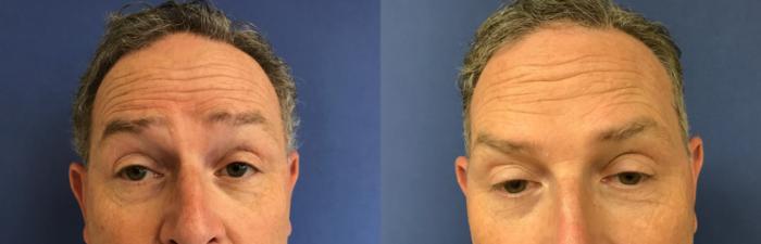 Before & After BOTOX® Cosmetic & Dysport® Case 348 Front View in Ann Arbor, MI