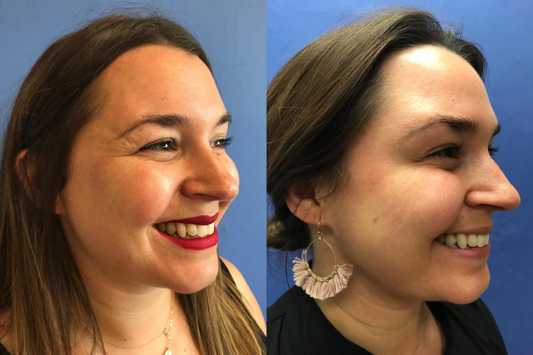 Before & After BOTOX® Cosmetic & Dysport® Case 349 Crow's Feet View in Ann Arbor, MI