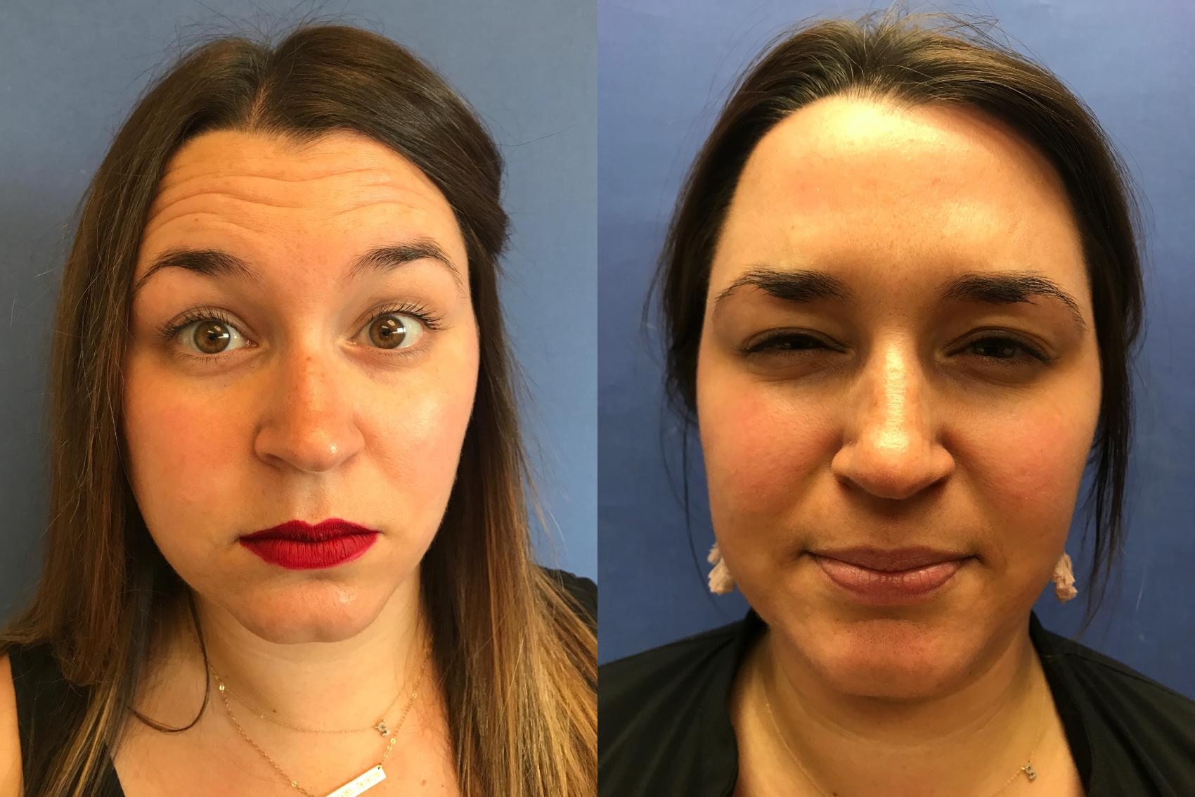 Before & After BOTOX® Cosmetic & Dysport® Case 349 Forehead View in Ann Arbor, MI
