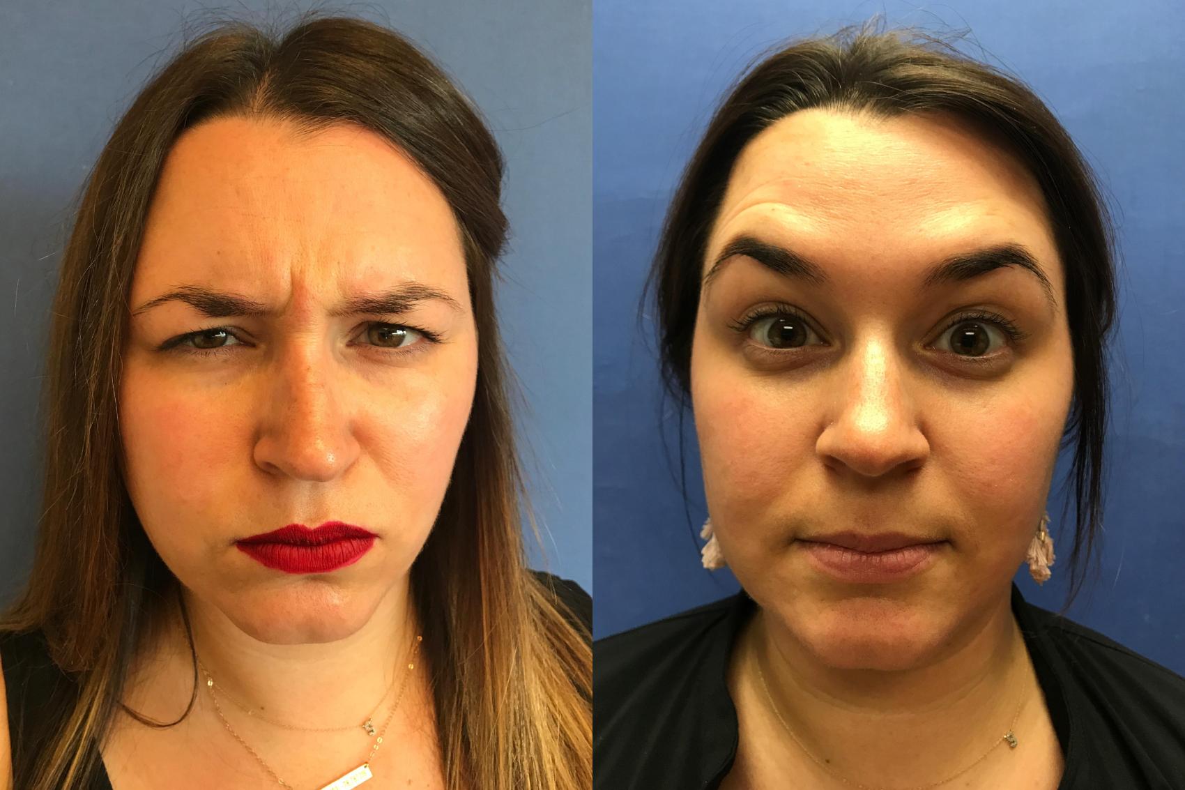 Before & After BOTOX® Cosmetic & Dysport® Case 349 Glabella View in Ann Arbor, MI