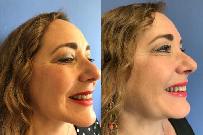 Before & After BOTOX® Cosmetic & Dysport® Case 350 Crow's Feet View in Ypsilanti, MI