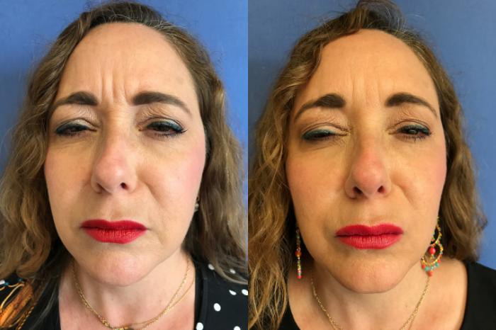 Before & After BOTOX® Cosmetic & Dysport® Case 350 Glabella View in Ypsilanti, MI