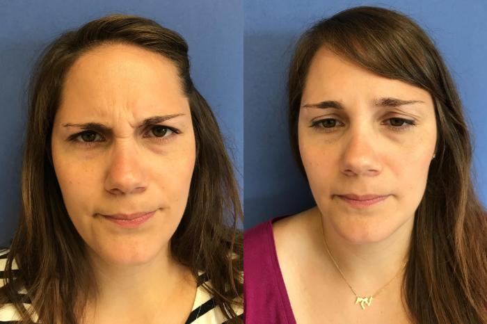 Before & After BOTOX® Cosmetic & Dysport® Case 351 Front View in Ypsilanti, MI
