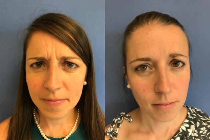 Before & After BOTOX® Cosmetic & Dysport® Case 352 Front View in Ann Arbor, MI