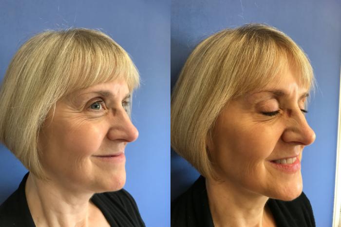Before & After BOTOX® Cosmetic & Dysport® Case 354 Crow's Feet View in Ann Arbor, MI