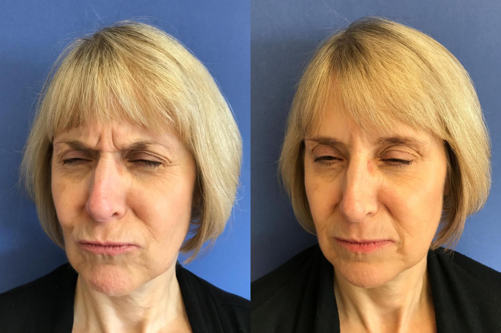 Before & After BOTOX® Cosmetic & Dysport® Case 354 Glabella View in Ann Arbor, MI