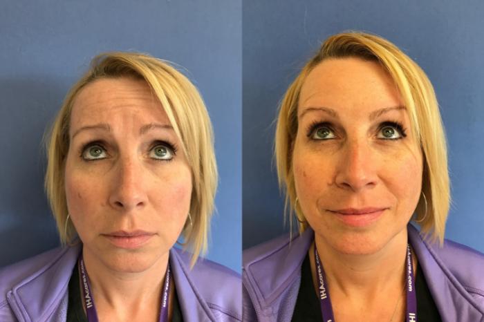 Before & After BOTOX® Cosmetic & Dysport® Case 355 Forehead View in Ann Arbor, MI