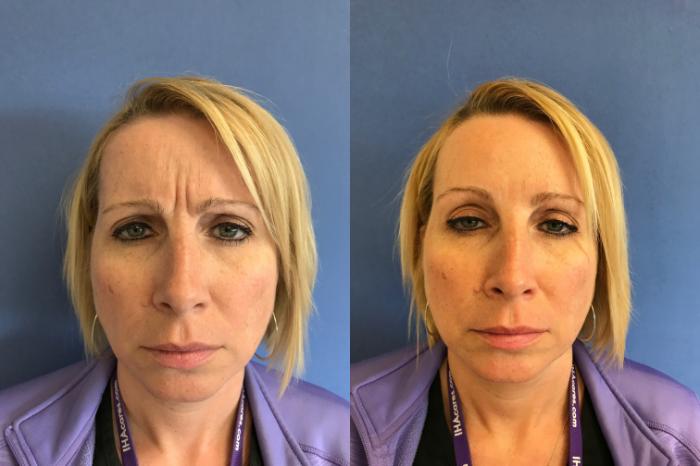 Before & After BOTOX® Cosmetic & Dysport® Case 355 Glabella View in Ann Arbor, MI