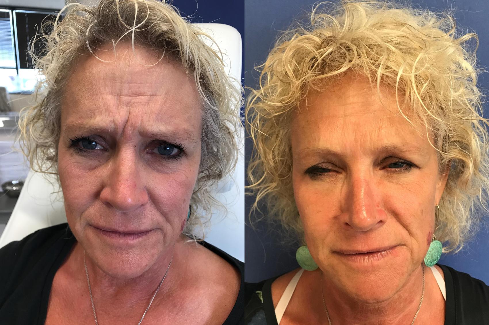 Before & After BOTOX® Cosmetic & Dysport® Case 356 Front View in Ann Arbor, MI