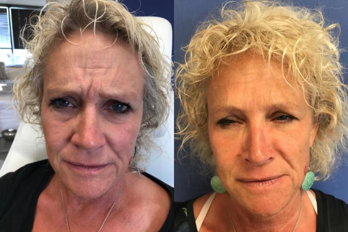 Before & After BOTOX® Cosmetic & Dysport® Case 356 Front View in Ypsilanti, MI