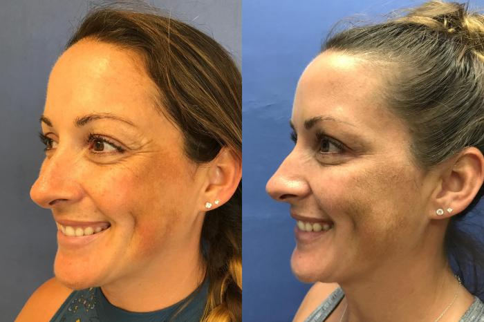 Before & After BOTOX® Cosmetic & Dysport® Case 357 Crow's Feet View in Ann Arbor, MI