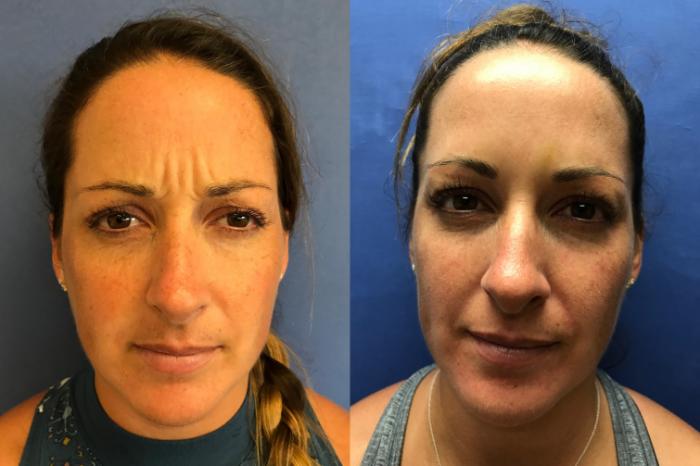 Before & After BOTOX® Cosmetic & Dysport® Case 357 Glabella View in Ann Arbor, MI