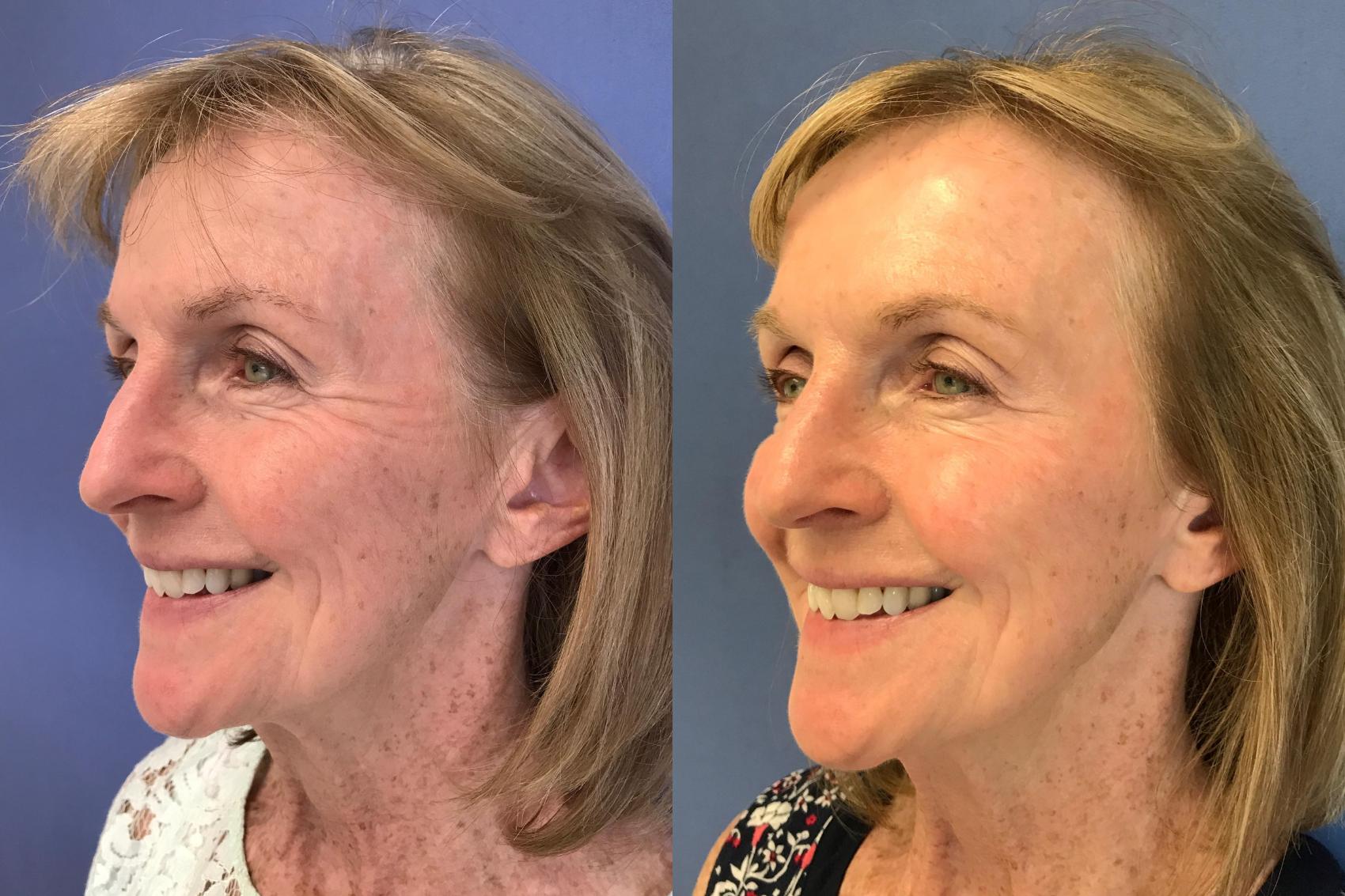 Before & After BOTOX® Cosmetic & Dysport® Case 359 Crow's Feet View in Ann Arbor, MI