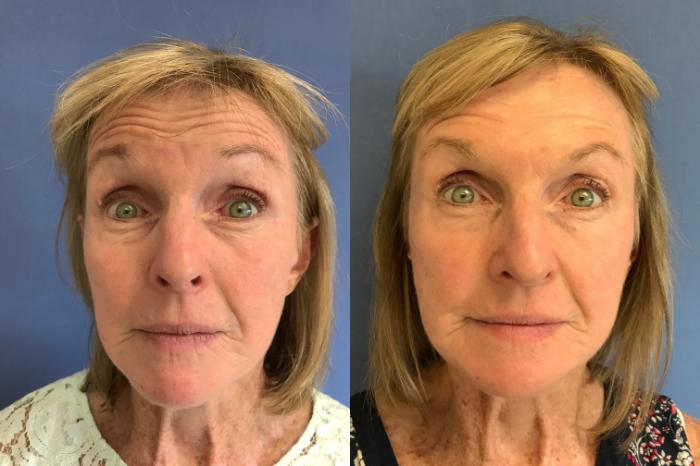 Before & After BOTOX® Cosmetic & Dysport® Case 359 Forehead View in Ann Arbor, MI