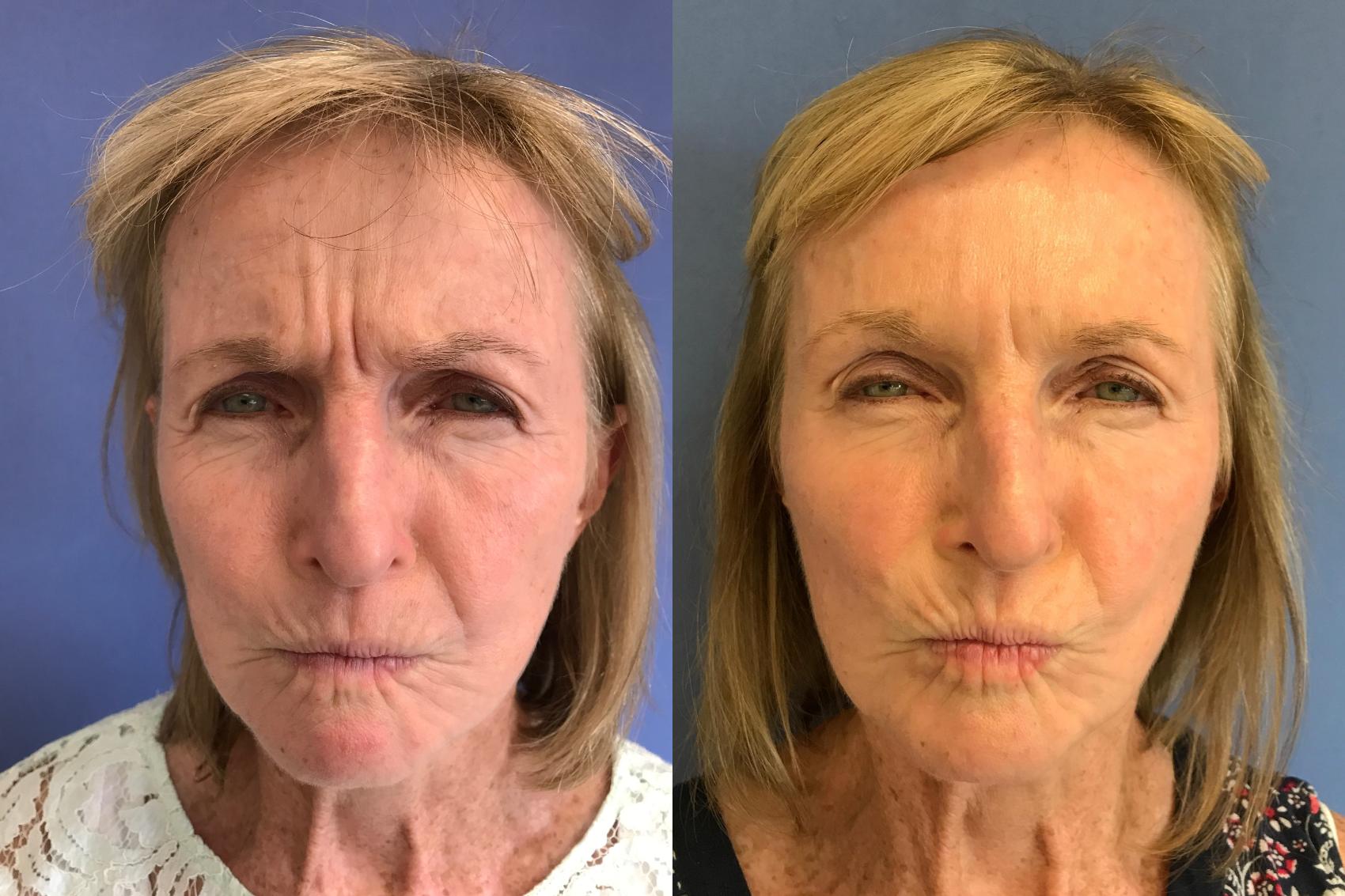 Before & After BOTOX® Cosmetic & Dysport® Case 359 Glabella View in Ann Arbor, MI