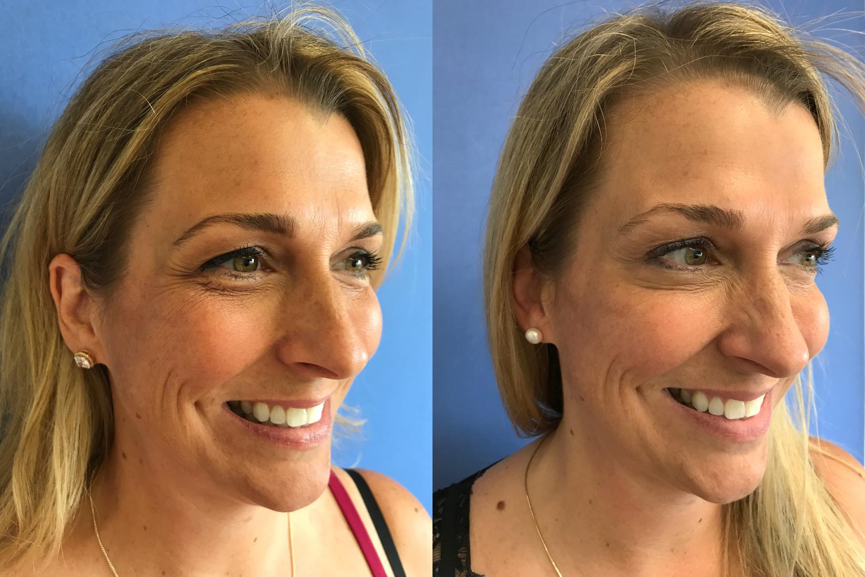 Before & After BOTOX® Cosmetic & Dysport® Case 361 Right Oblique View in Ann Arbor, MI