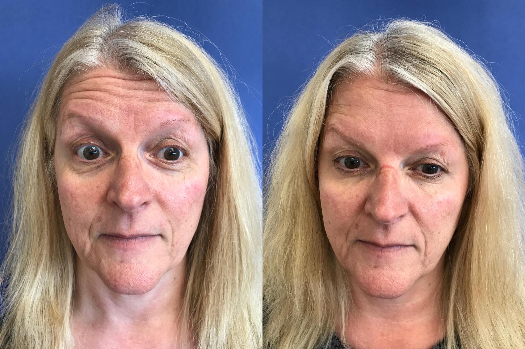 Before & After BOTOX® Cosmetic & Dysport® Case 362 Front View in Ann Arbor, MI